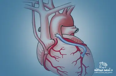 جراحة-مجازة-الشريان-التاجي